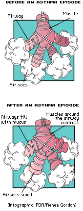 Asthma Before and After